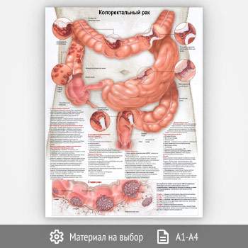 Плакат «Колоректальный рак» (ЗОЖ-14, 1 лист)